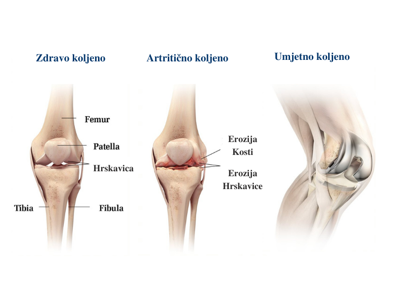 Ugradnja endoproteza koljena