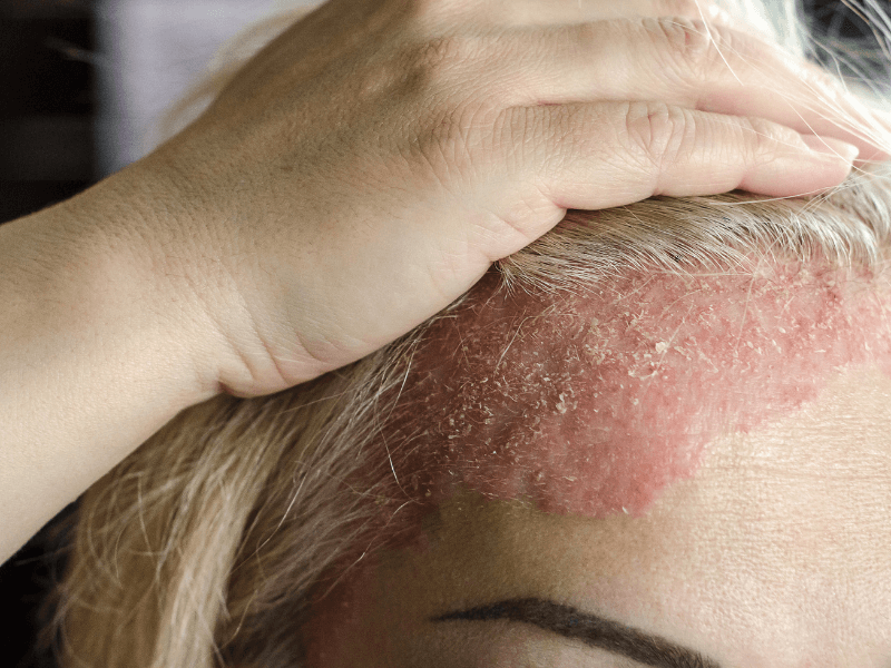Dermatologija liječi kožne bolesti